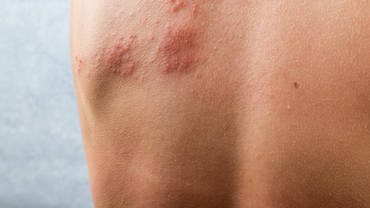 Shingles: Acupuncture Can Help!