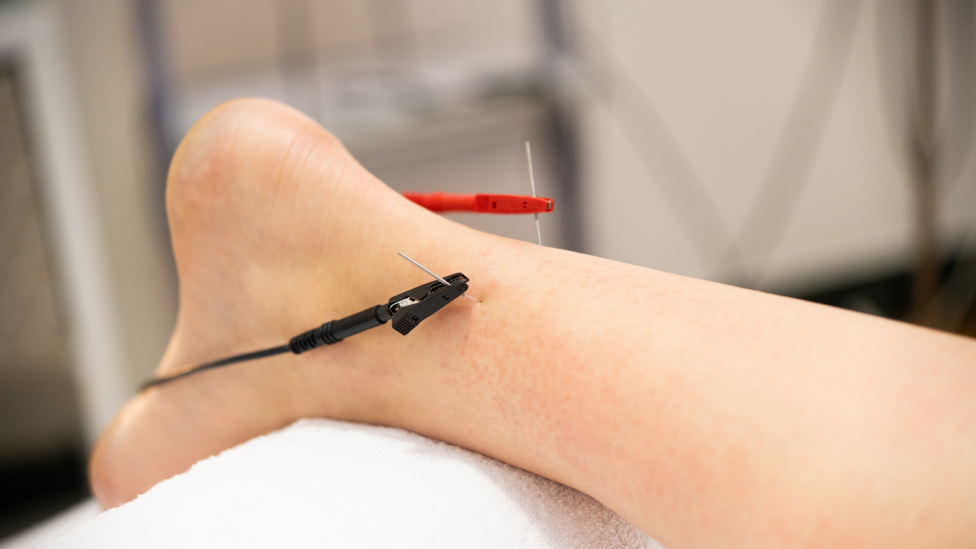 Peripheral Neuropathy Relief with Acupuncture | Acupuncture of West Florida 